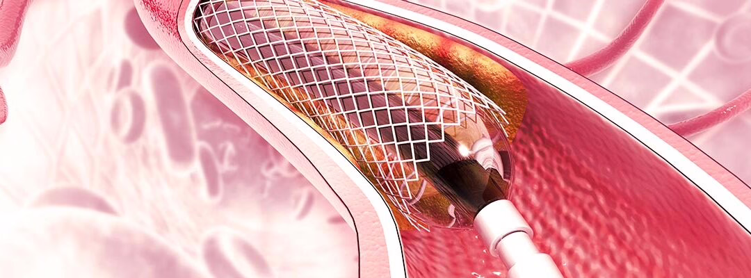 Angina de pecho resistente puede tratarse con angioplastia